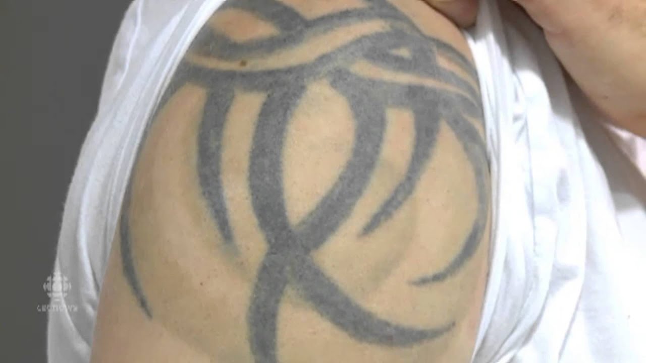 Tattoo removal in action