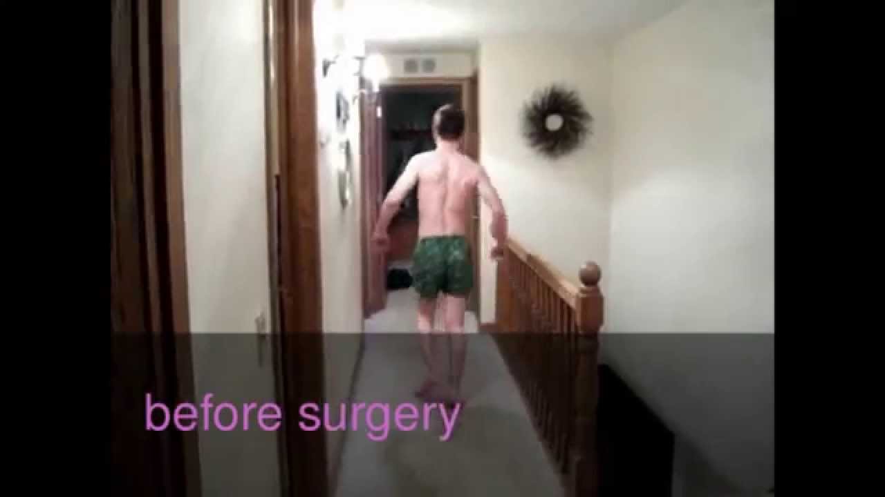 Before and after surgery walking with cerebral palsy 2