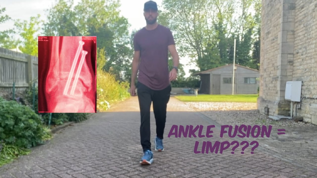 Ankle Fusion: Will I walk with a limp after ankle fusion???