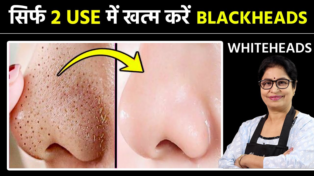 चेहरे के Blackheads, Whiteheads, Open Pores व दाग धब्बों से 100% छुटकारा पाएं | DIY Face Scrub/Mask