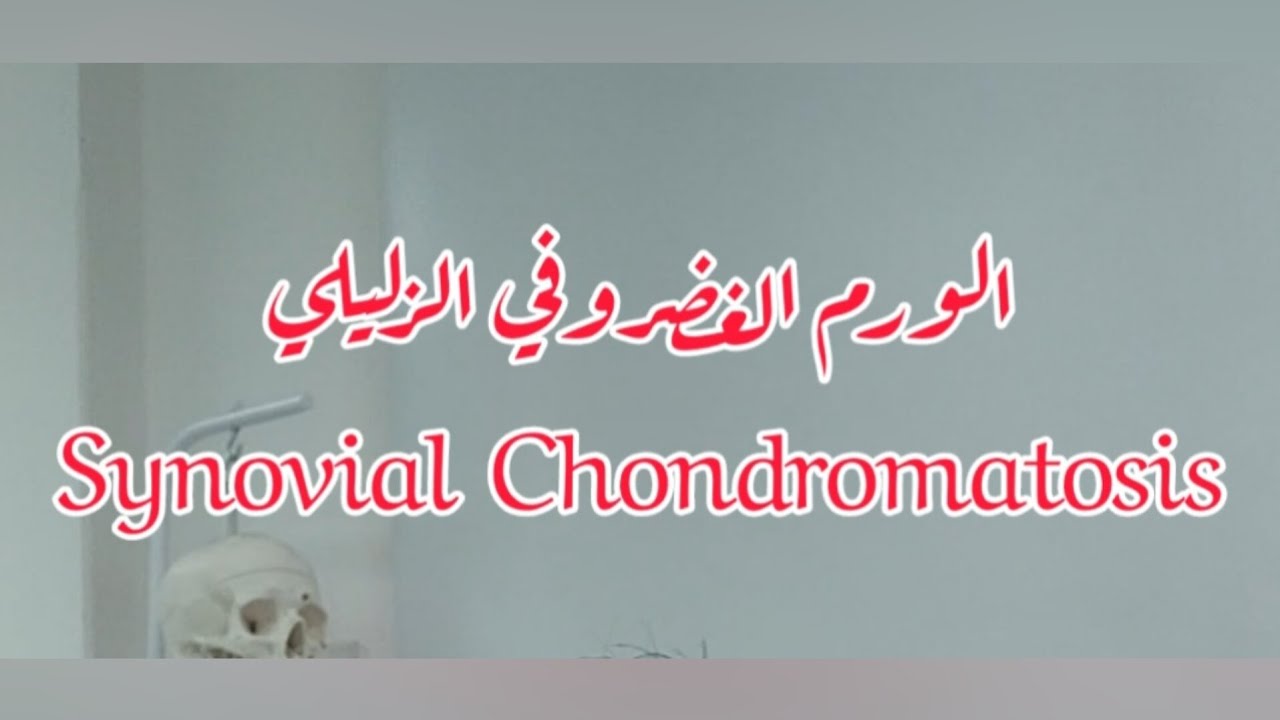 الورم الغضروفي الزليلي بالركبة Knee Synovial Chondromatosis