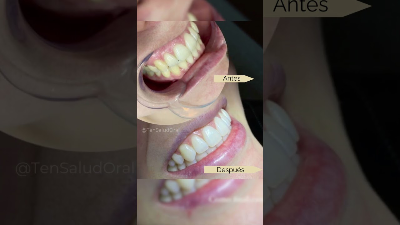 De opaco a WOW: antes y despu&eacute;s de un blanqueamiento dental ✨
