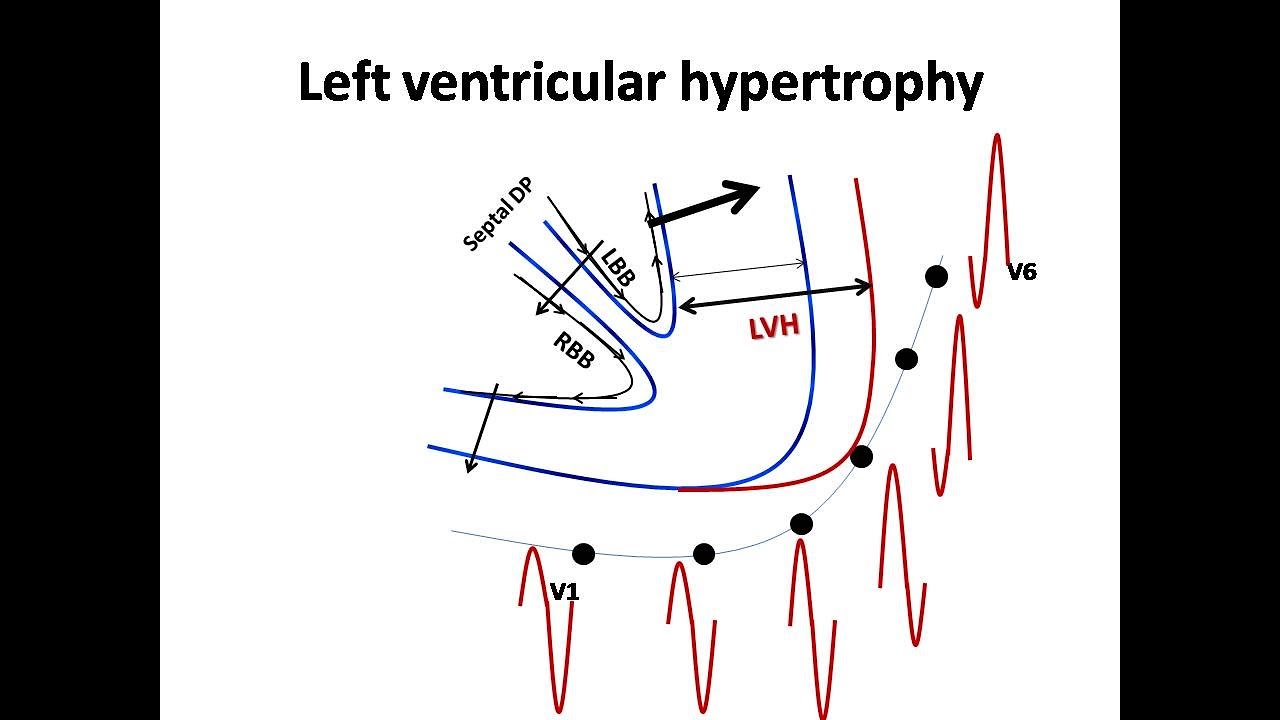 ECG course: Ventricular Enlargement, Dr. Sherif Altoukhy