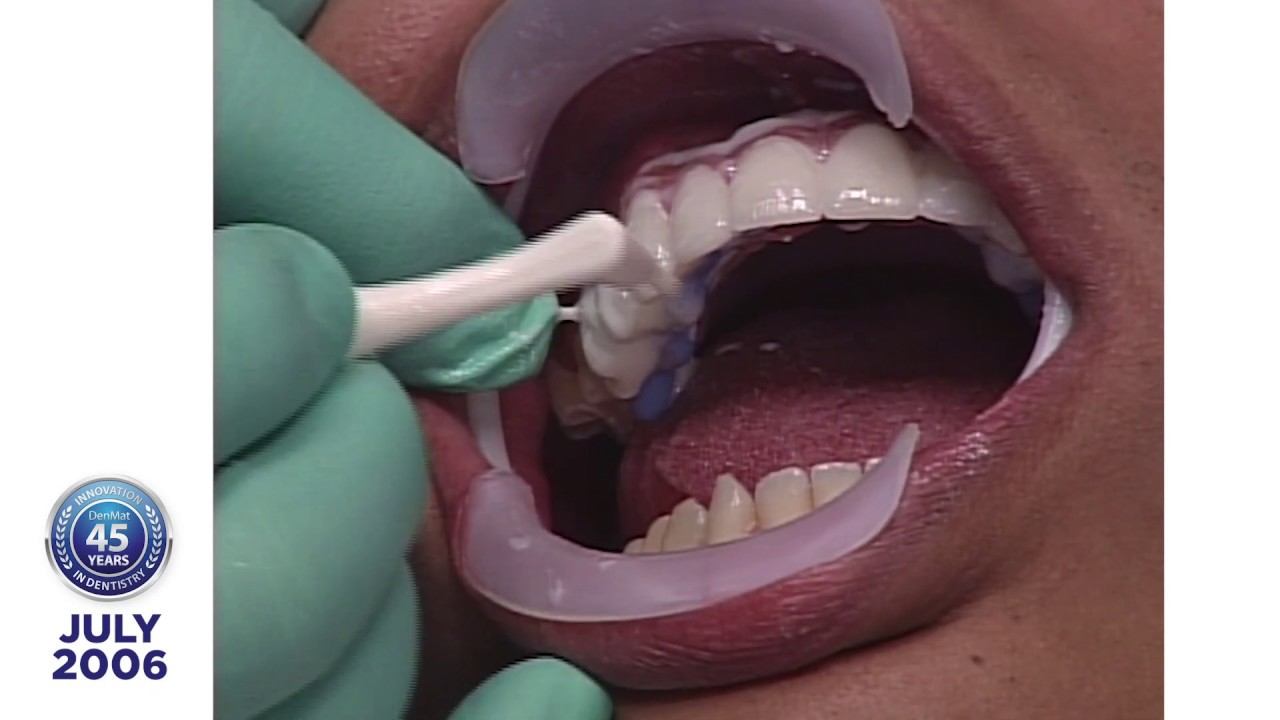 Dr. Robert Ibsen Presents Jay R., a Lumineers® Clinical Case Presentation: 2006