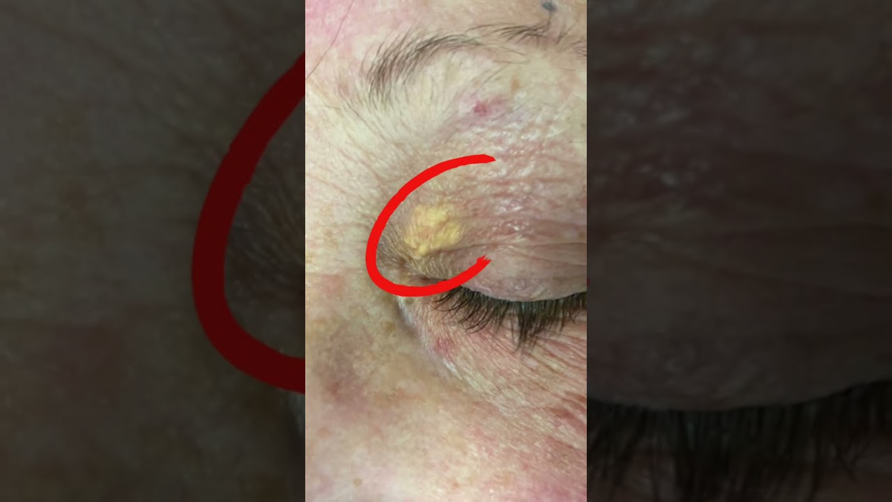 Xanthelasma Removal by Dr. Shafa #xanthelasma #skin #dermatology #dermatologist #shorts #eyelids