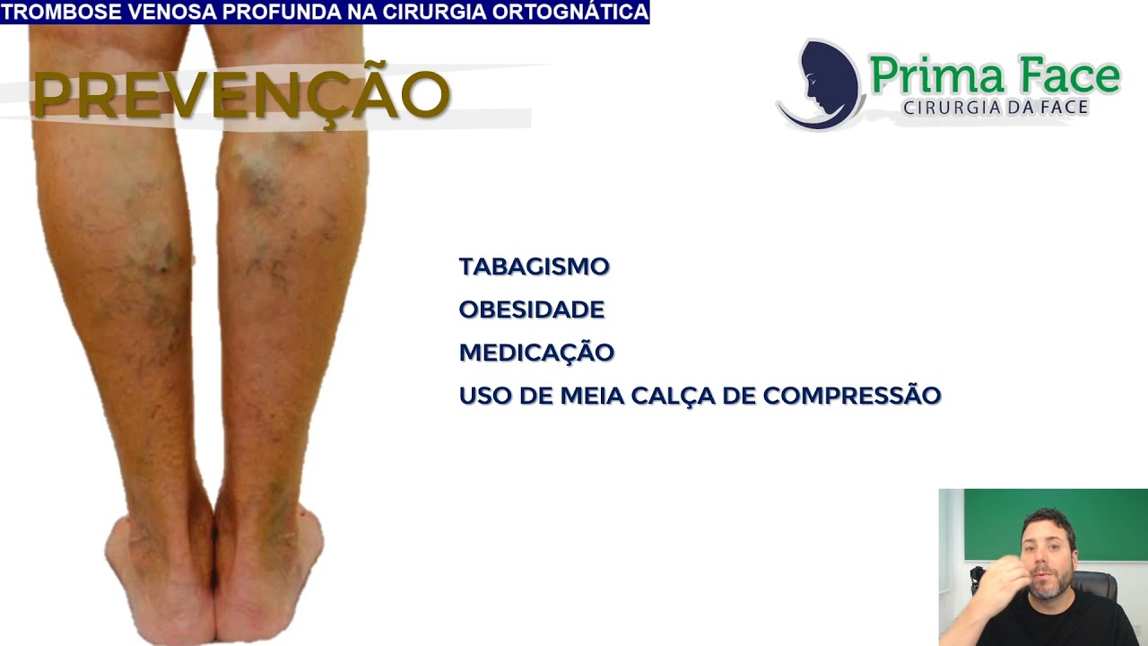 TROMBOSE VENOSA PROFUNDA E CIRURGIA ORTOGNÁTICA. EXISTE RISCO?