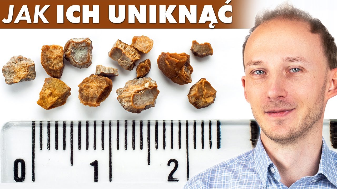 Kamienie nerkowe: te 8 błędów w diecie zwiększa ich ryzyko! Kamica nerkowa | Dr Bartek Kulczyński
