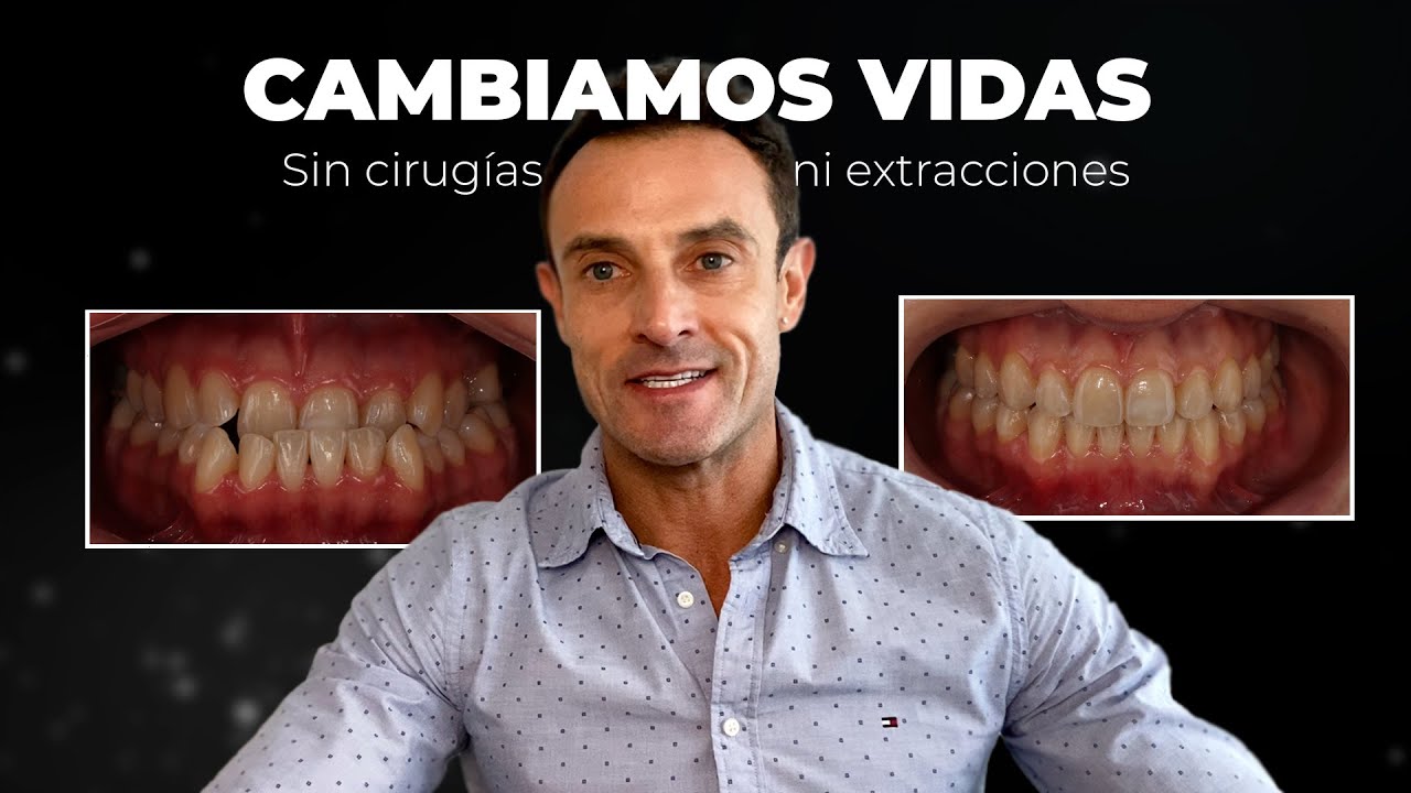 💊 Tratamiento para MORDIDA clase 3 *(SIN CIRUGÍA NI EXTRACCIONES)*