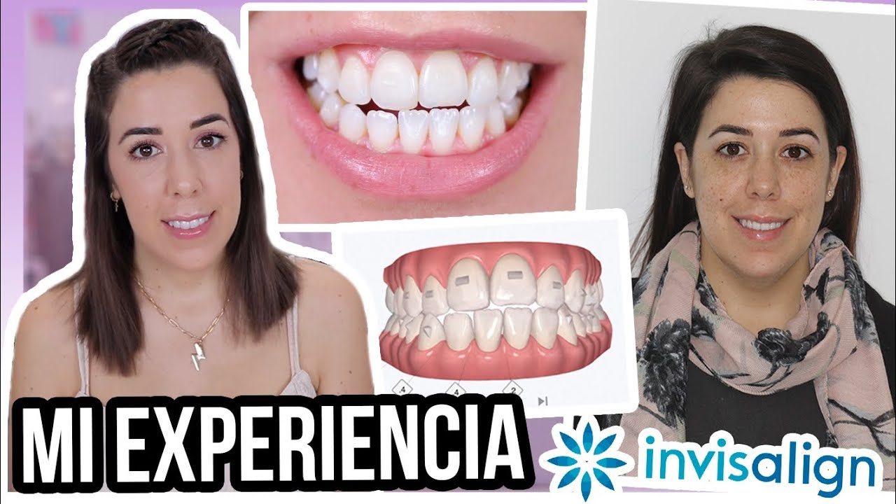 Mi experiencia con INVISALIGN | ¿CUÁNTO CUESTA? ¿TIEMPO? ¿ESTOY CONTENTA?