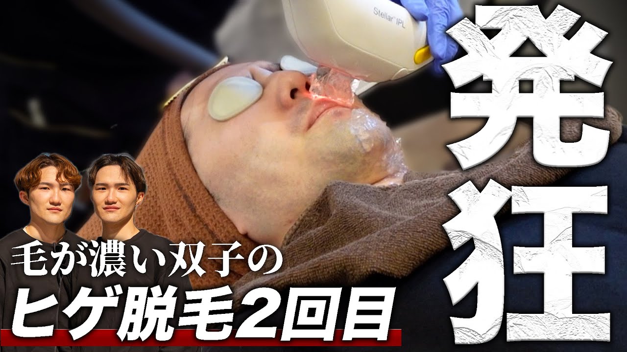 【メンズ脱毛】毛が濃い双子のヒゲ脱毛2回目。痛過ぎて発狂。効果は絶大。