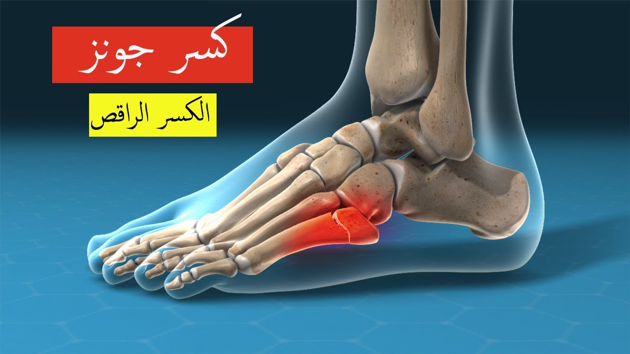 كسر جونز – كسر القاعدة المشطية الخامسة (الكسر الراقص)