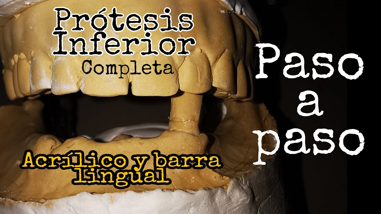 Prótesis inferior completa con barra lingual PASO A PASO - VÍDEO ESTRENO