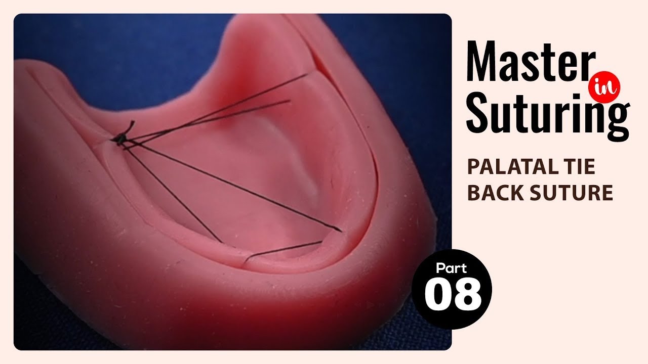 Palatal Tie Back Suturing Made Simple: Learn the Procedure