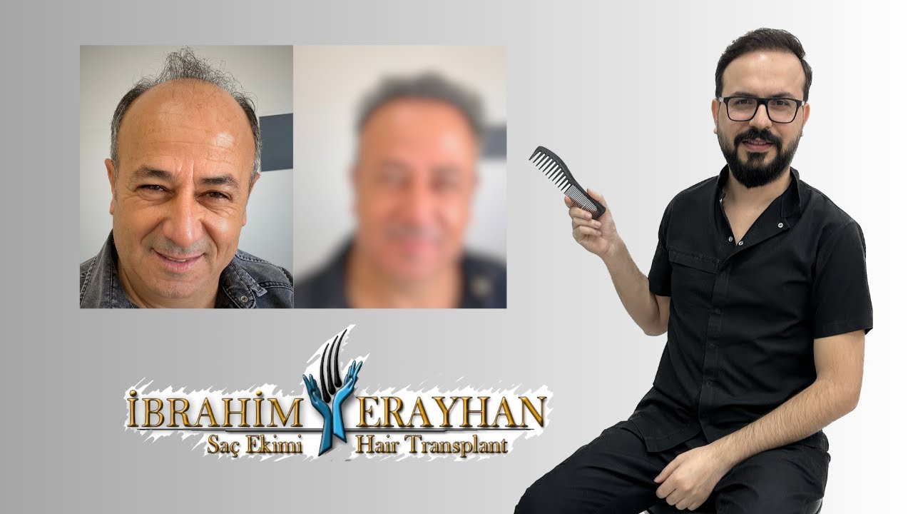 Saç Ekimi İle Gelen Harika Değişim | The Amazing Change That Comes With Hair Transplantation