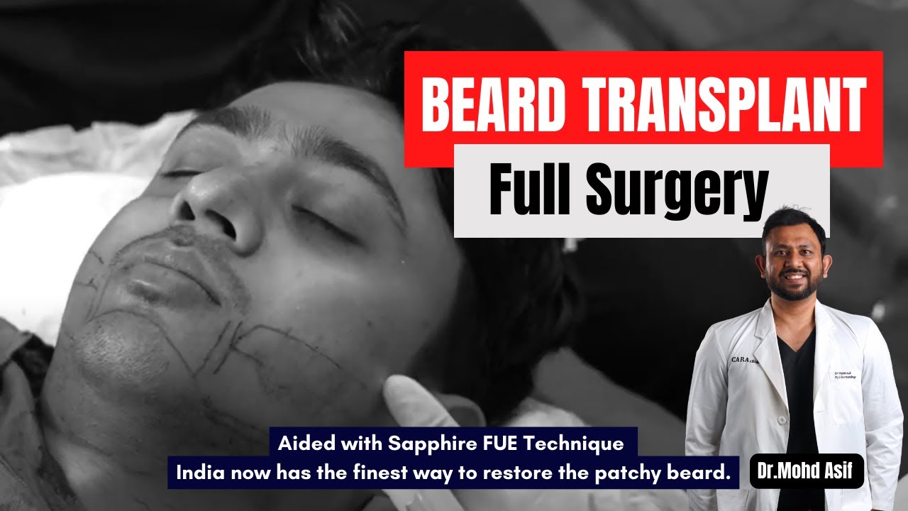Beard transplant in India at Cara clinic Mumbai