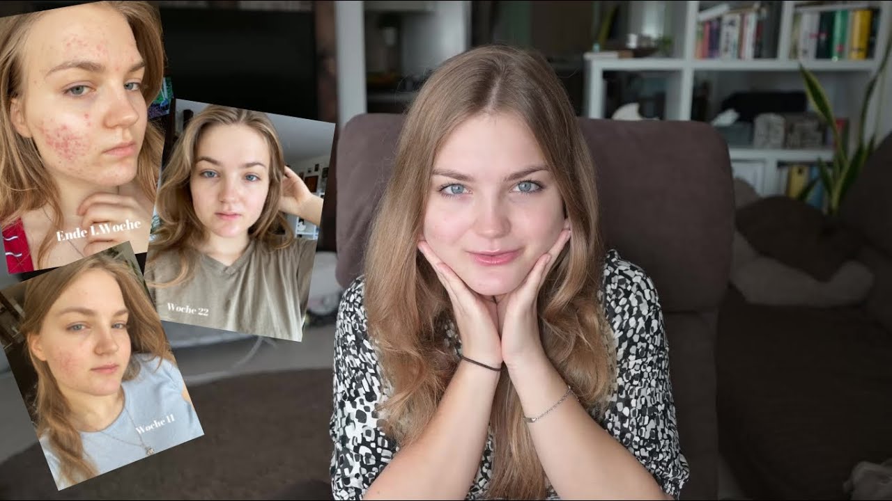 Akne Update // 6 Monate ISOTRETINOIN und die Narben verheilen langsam!