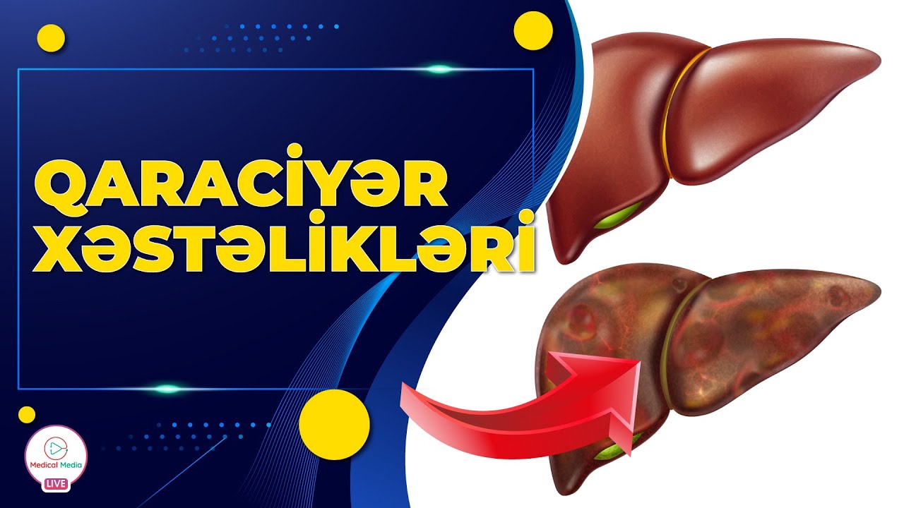 QARACİYƏR XƏSTƏLİKLƏRİNİN ƏLAMƏTLƏRİ / QARACİYƏR XƏSTƏLİKLƏRİNİN M&Uuml;ALİCƏSİ / HEPATOLOQ