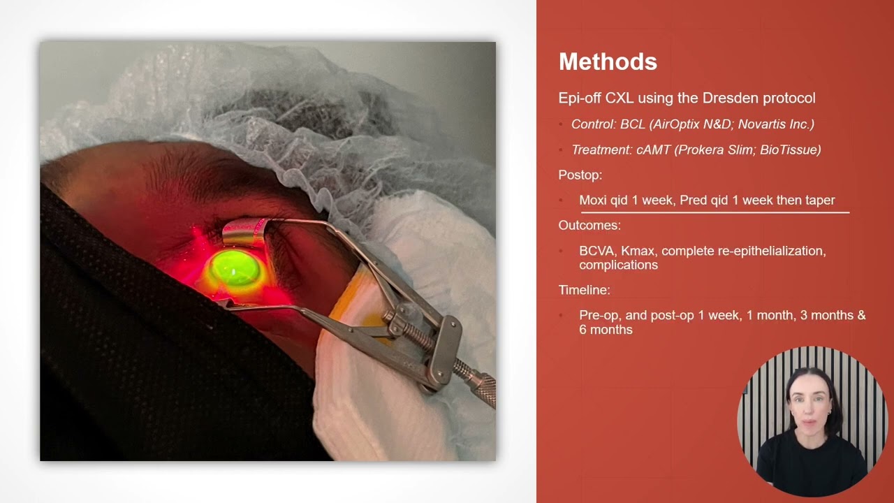 Corneal cross-linking in keratoconus patients – Video abstract [569518]