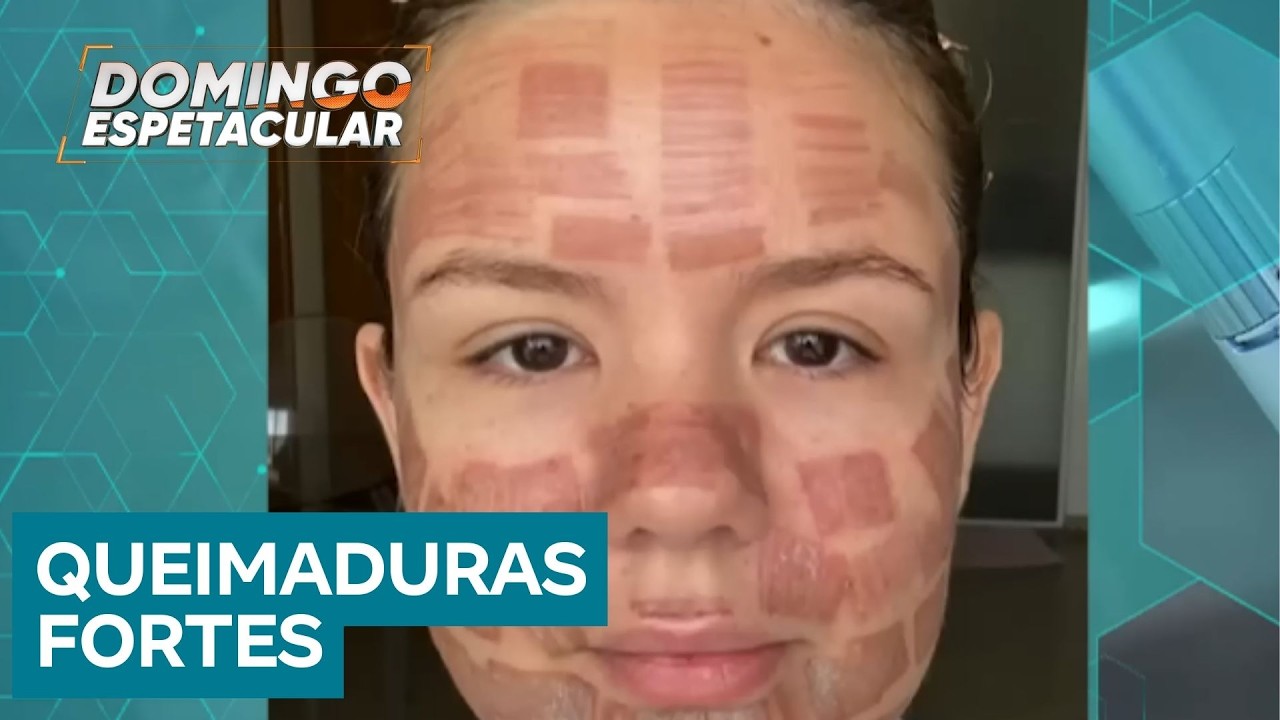 Pacientes modelo sofrem queimaduras graves durante procedimento est&eacute;tico com laser de CO2