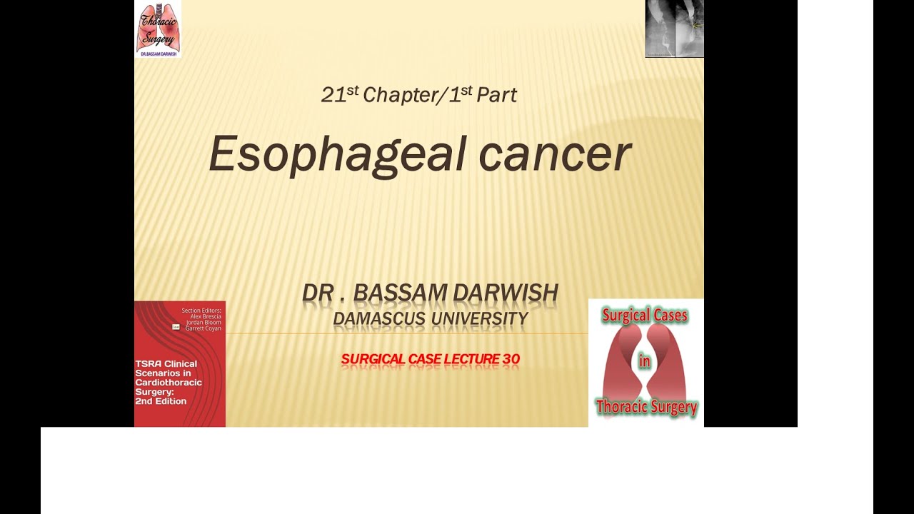 21st Chapter1st Part  Esophageal cancer القسم الأول من محاضرة سرطان المري