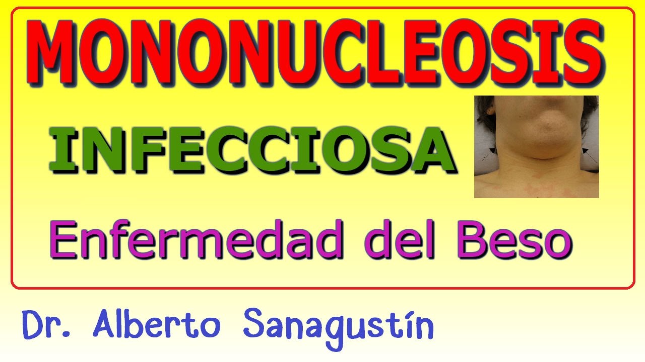 MONONUCLEOSIS INFECCIOSA (ENFERMEDAD DEL BESO)