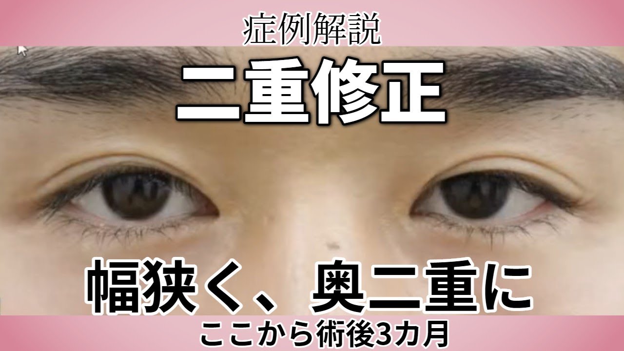二重修正の症例解説。二重幅狭く、一重瞼のような奥二重を希望。手術後3カ月