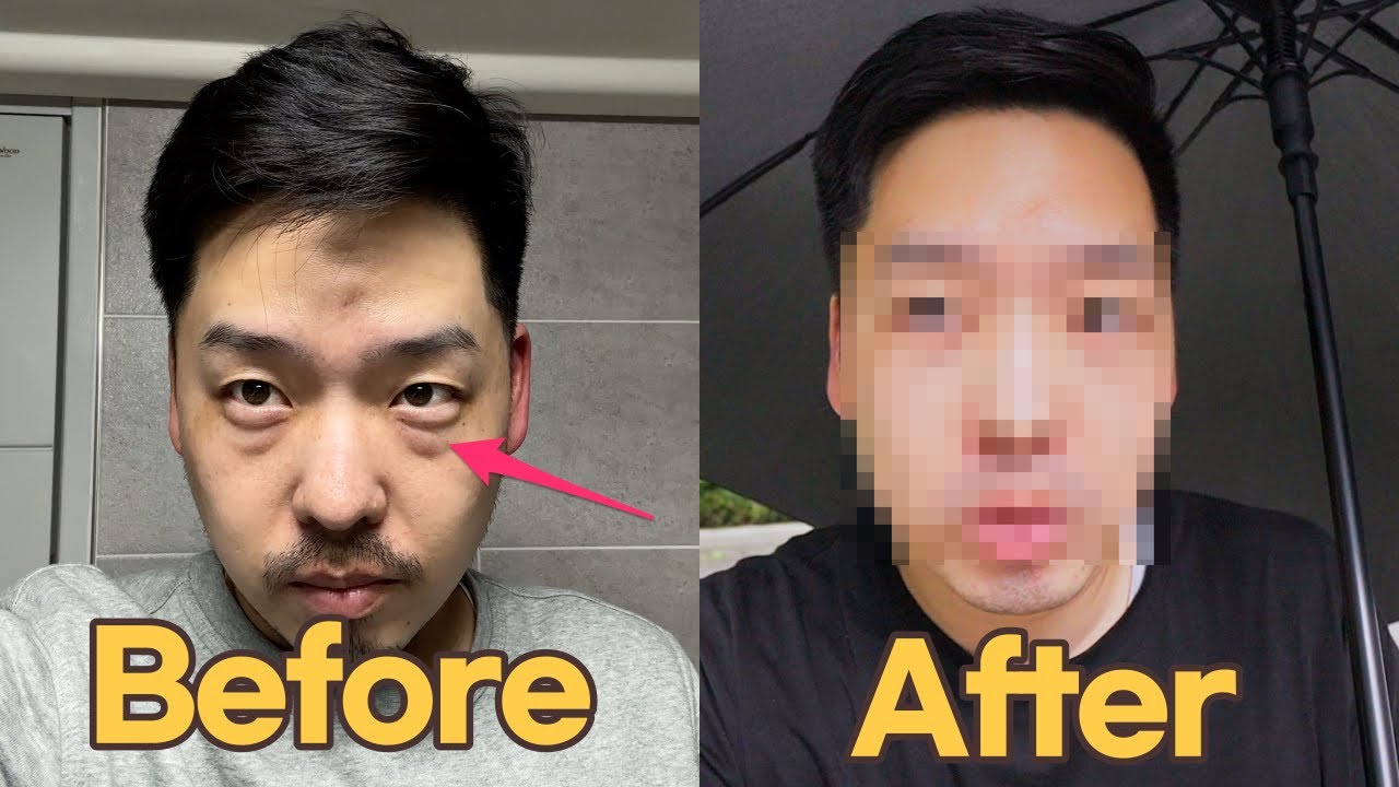 성형 했습니다 (ft. 눈밑지방재배치)