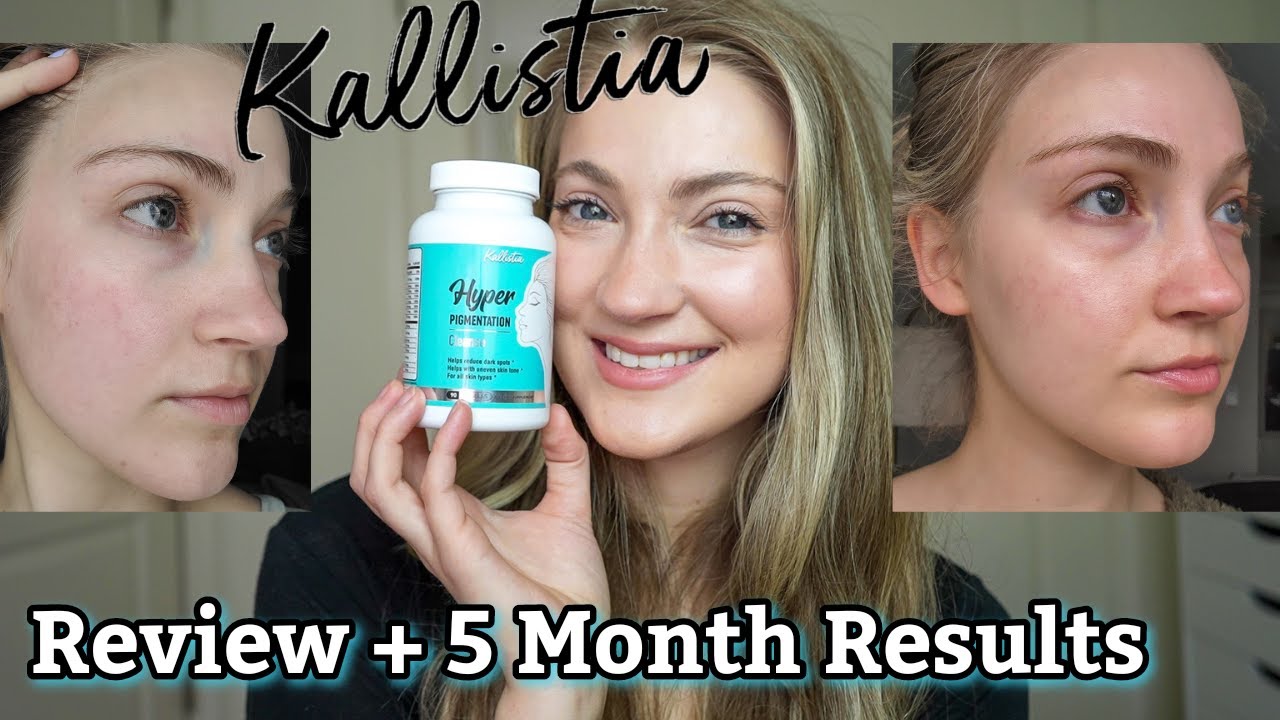 Kallistia Hyperpigmentation Cleanse Review & 5 Month Results