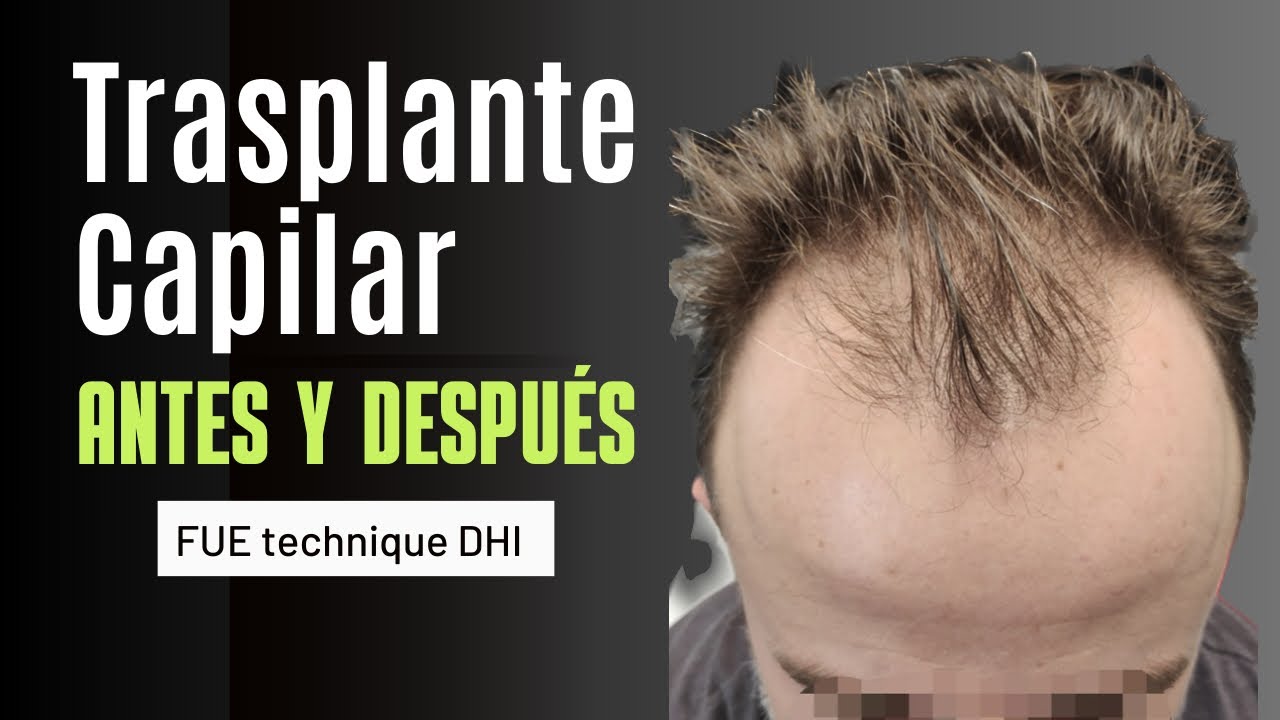 TRASPLANTE CAPILAR | 3.178 UF's | Hair Transplant before after | Hair Transplant results