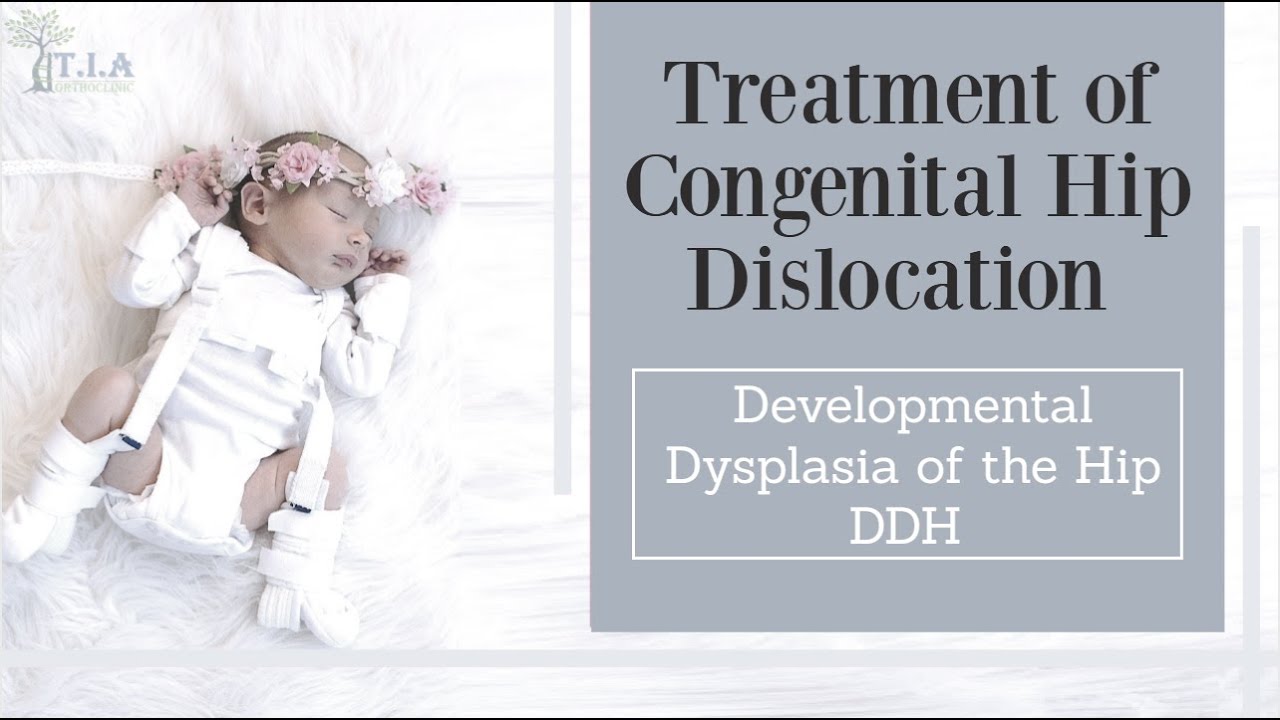 congenital hip dislocation treatment - Developmental Dysplasia of the Hip (DDH) (subtitled)
