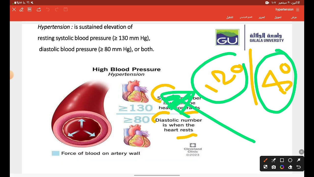 Hypertension | شرح ارتفاع ضغت الدم