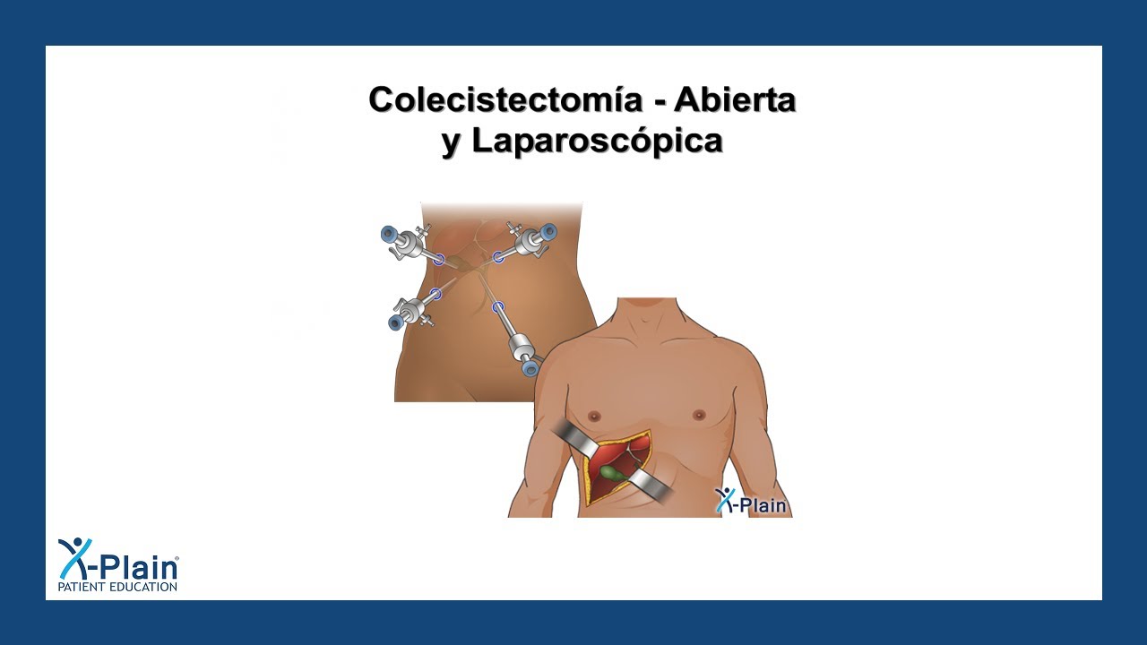 Colecistectom&iacute;a - Abierta y laparosc&oacute;pica