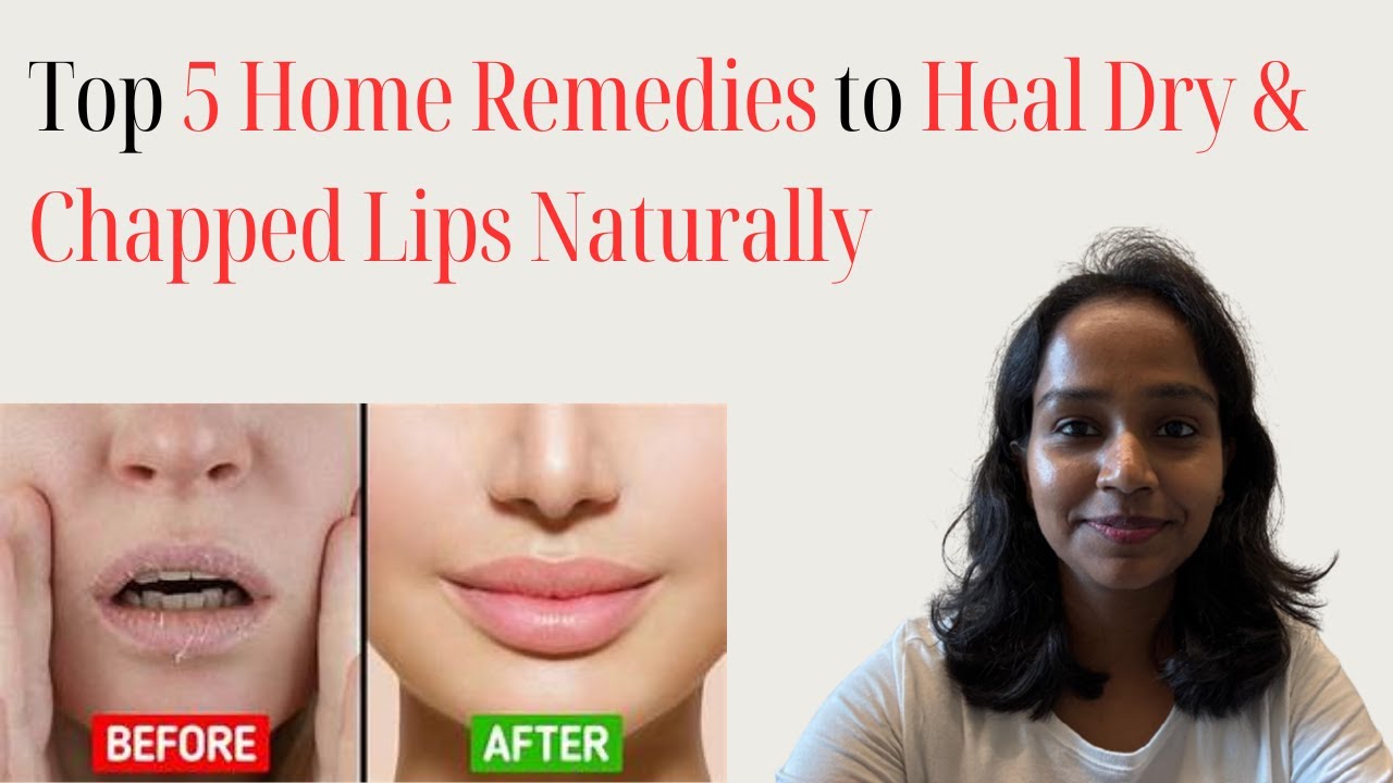 Top 5 Home Remedies to Heal Dry & Chapped Lips Naturally 