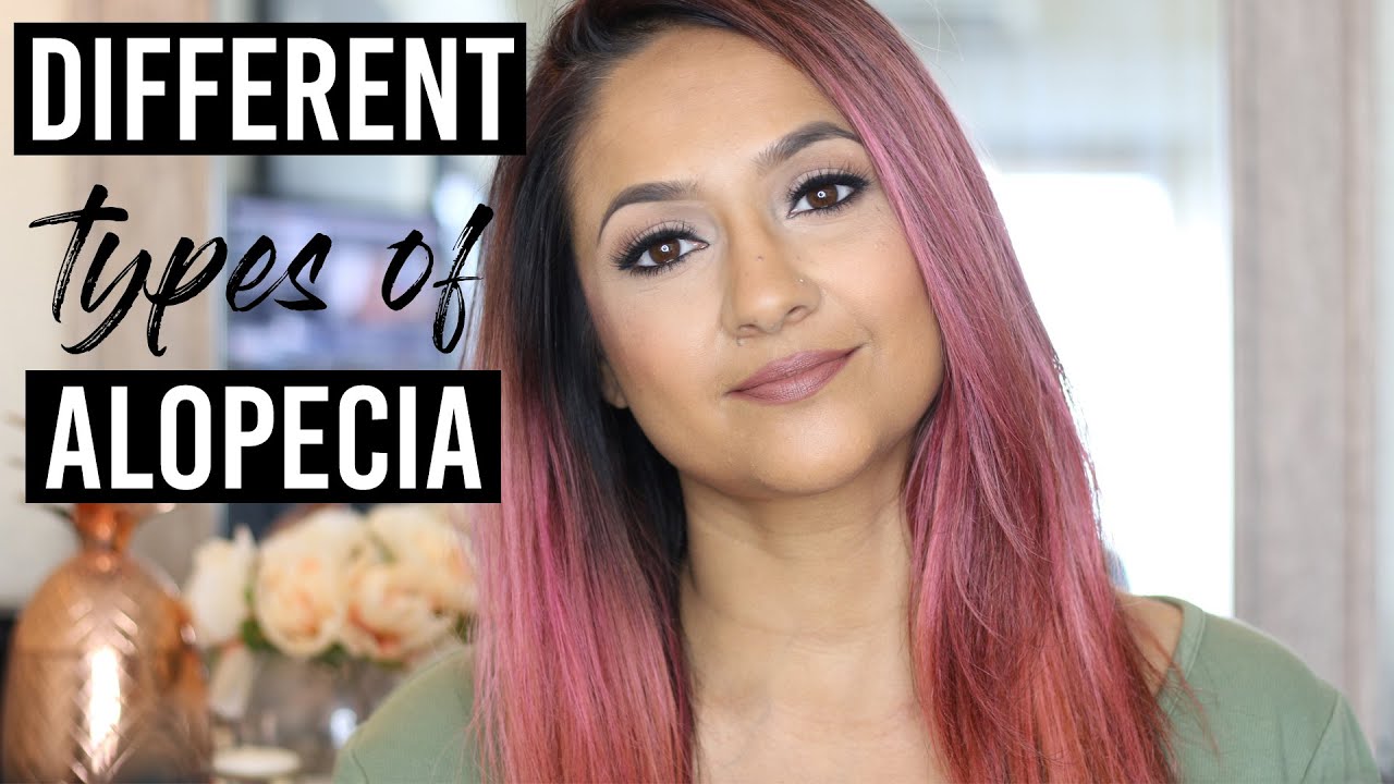The Different Kinds of Alopecia or Hair Loss that Exist