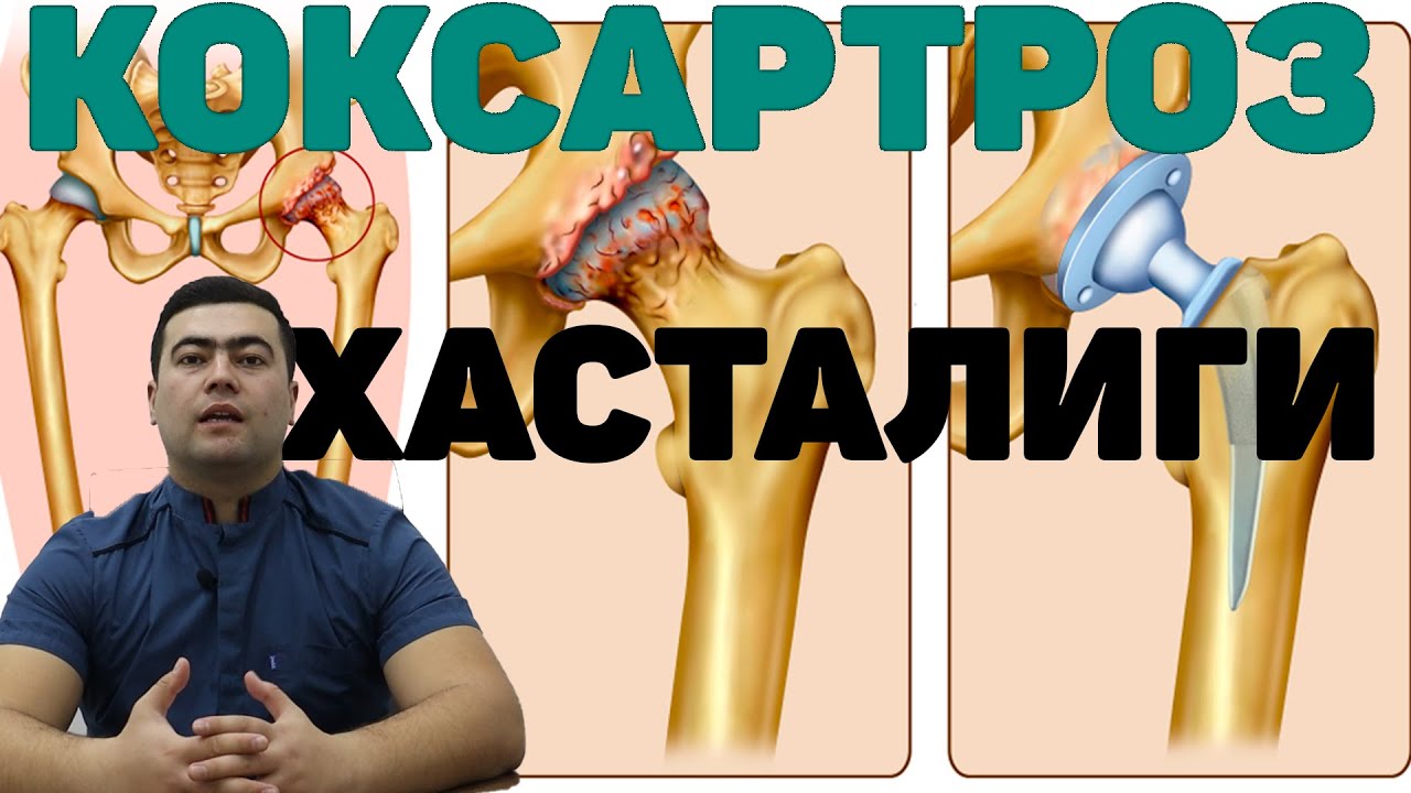 КОКСАРТРОЗ ХАСТАЛИГИ КЕЛИБ ЧИКИШ САБАБЛАРИ ДАВО ЧОРАЛАРИ | KO`KSARTROZ XASTALIGI HAQIDA BATAFSIL