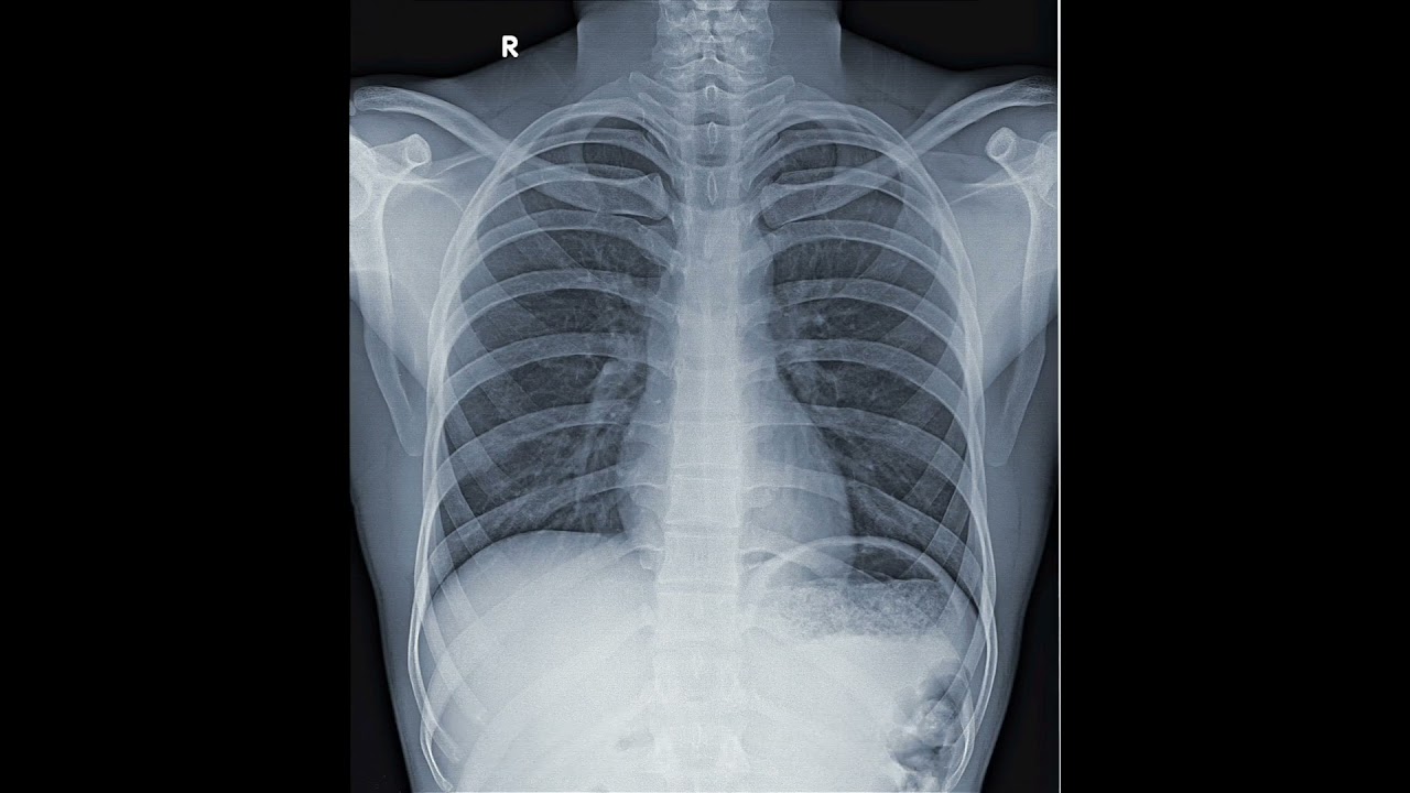 Normal X-Ray 🆚 Abnormal Consolidation X-Ray #aiims #biology