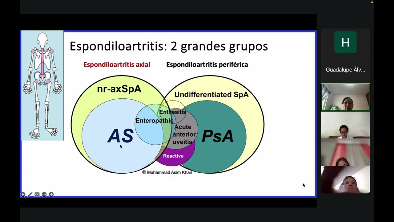 Espondiloartropatías