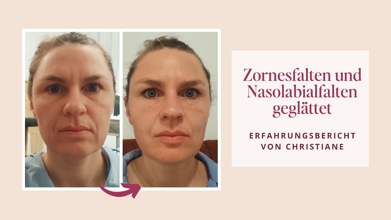 Zornesfalten und Nasolabialfalten geglättet - Erfahrungsbericht von Christiane