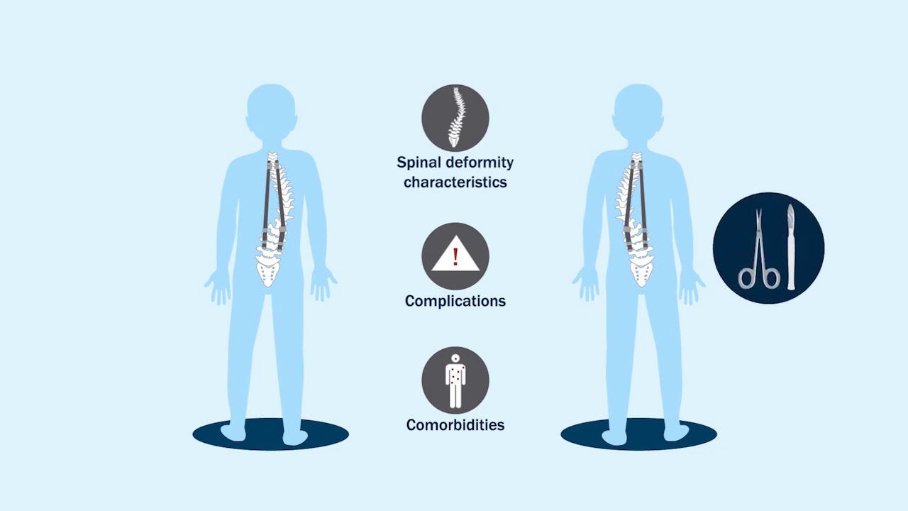 Risk Factors for  Reoperation Following Final Fusion After Treatment of  Early Onset Scoliosis...