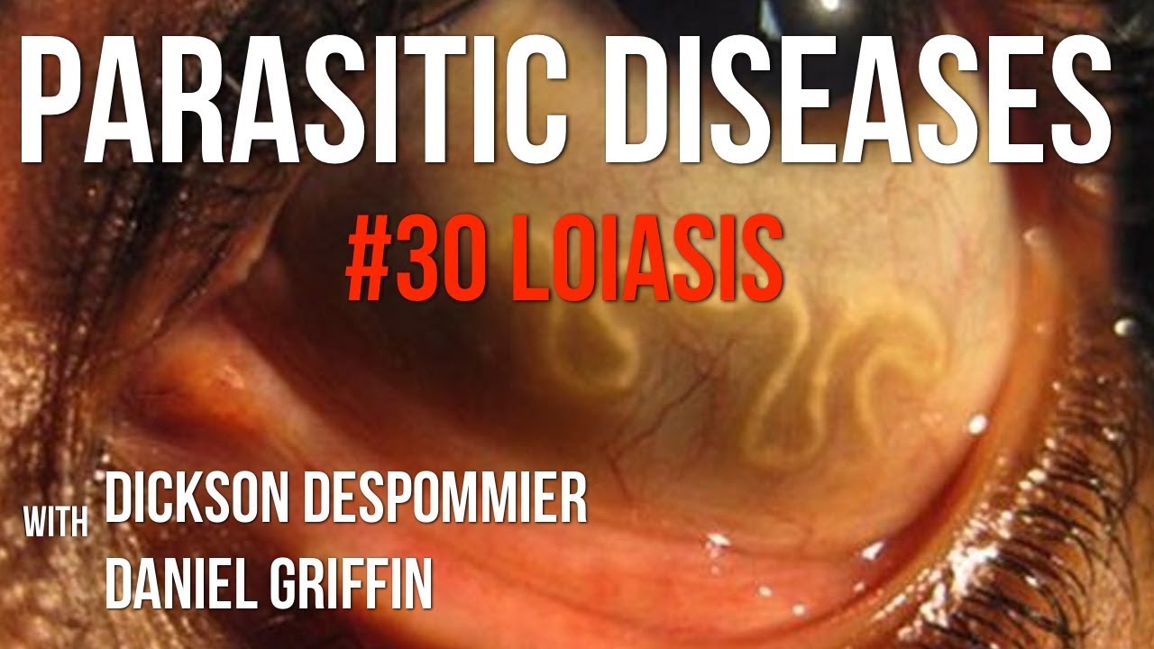 Parasitic Diseases Lectures #30: Loiasis