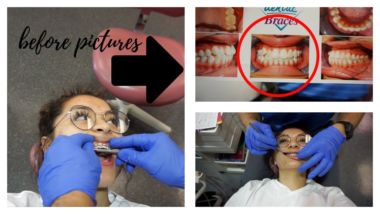 BRACES VLOG: they're coming off! + before pics of my ugly teeth hehe