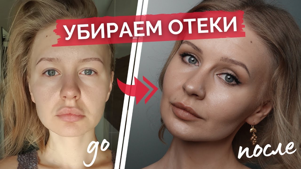 Склонность к отекам - ЛИЧНЫЙ ОПЫТ