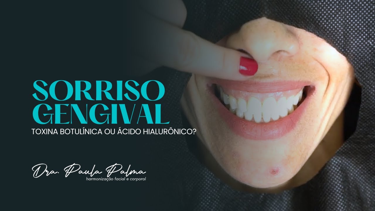 Toxina Botulínica ou Ácido Hialurônico para sorriso gengival?