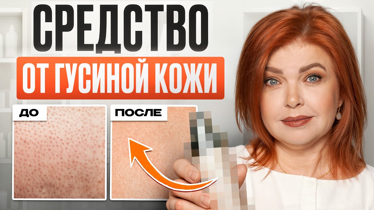 3 РАБОЧИХ способа избавиться от ГУСИНОЙ КОЖИ НАВСЕГДА! Ты еще ЭТО не пробовала!