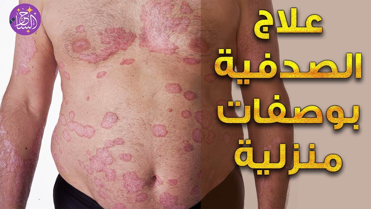 علاج الصدفية بوصفات منزلية فعالة