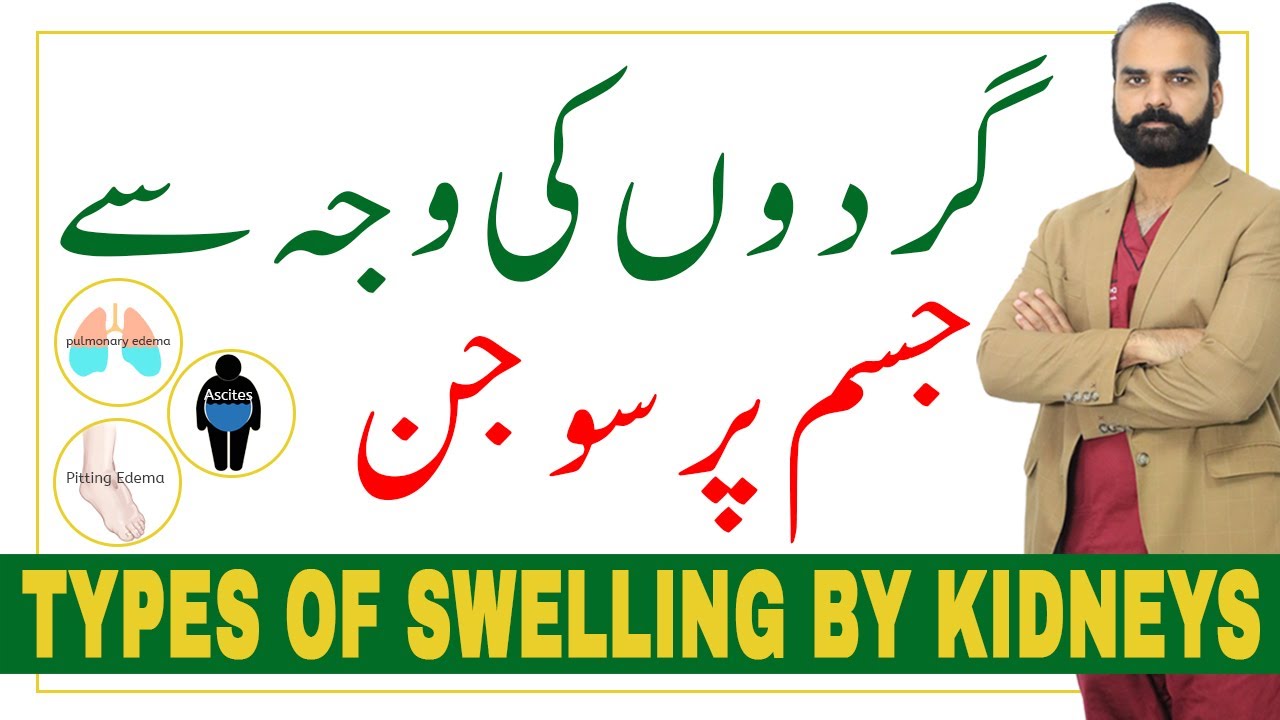 Types of Swelling by Kidneys, Understand the Difference 【Edema in Hindi/Urdu】