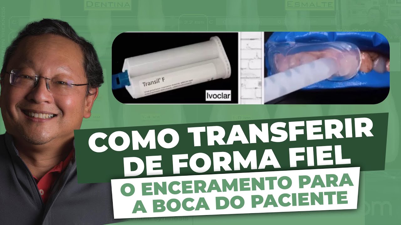 Facetas de resina: como transferir o enceramento para boca do paciente