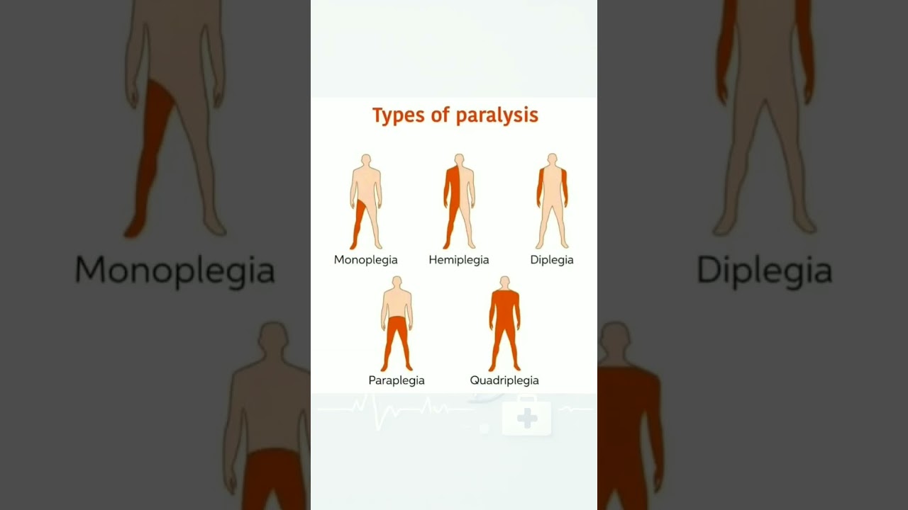 Types of Paralysis Explained! ⚡️#medicallearning #medicalknowledge #medicalstudent #nursingeducation