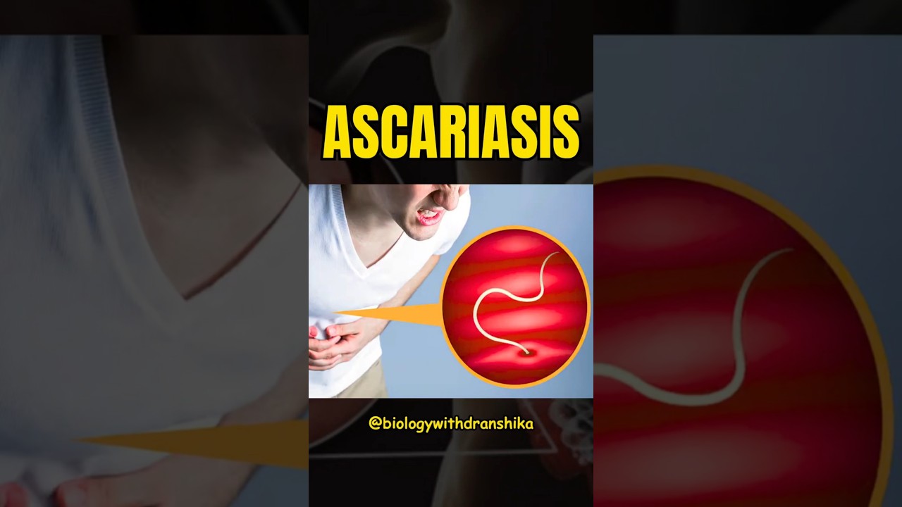 Ascariasis is a common intestinal infection caused by roundworms #pseudoxanthomaelasticum