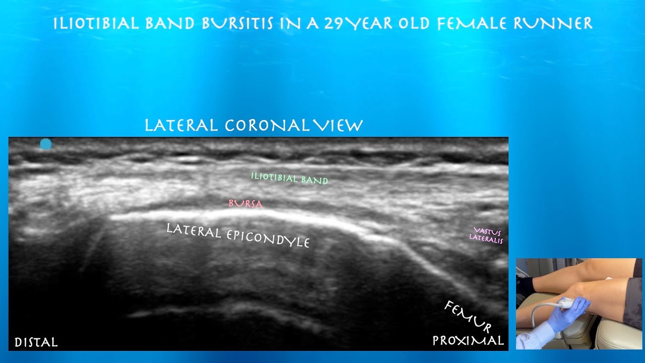 Ultrasound Iliotibial Band Bursitis,  by probeultrasound.com